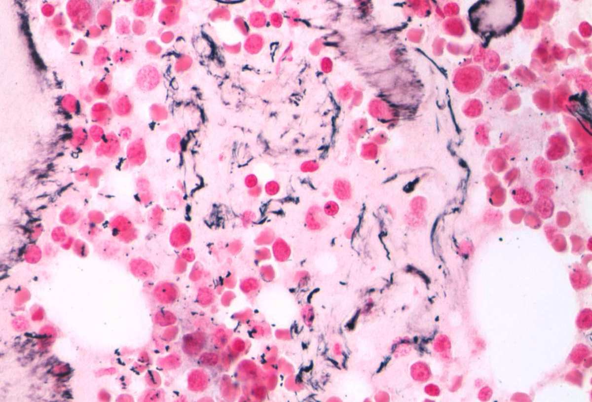 Biopsy reticulin stain.